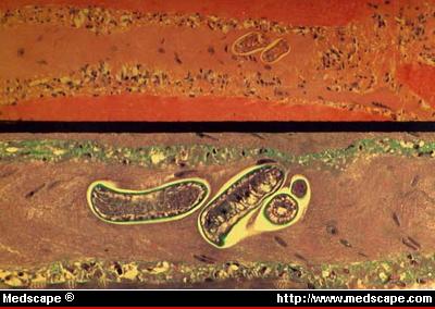 trichinellapseudospiralis